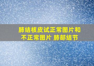 肺结核皮试正常图片和不正常图片 肺部结节